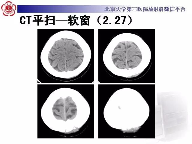 【病例】颅骨巨细胞修复性肉芽肿1例X线CT