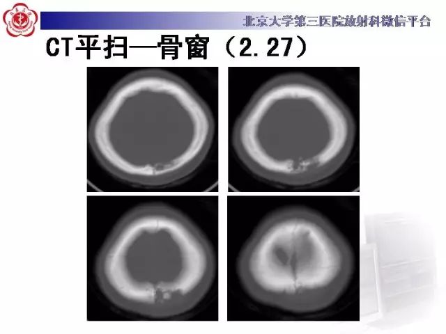 【病例】颅骨巨细胞修复性肉芽肿1例X线CT