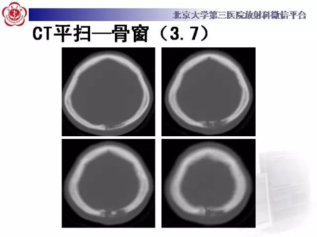 【病例】颅骨巨细胞修复性肉芽肿1例X线CT