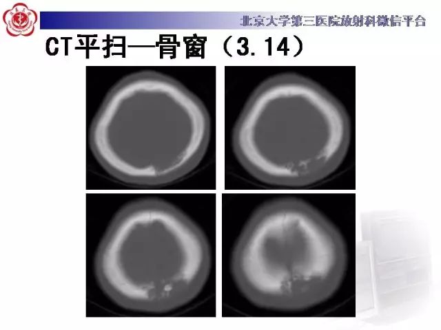 【病例】颅骨巨细胞修复性肉芽肿1例X线CT