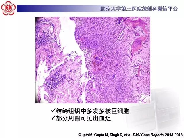 【病例】颅骨巨细胞修复性肉芽肿1例X线CT