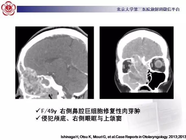 【病例】颅骨巨细胞修复性肉芽肿1例X线CT