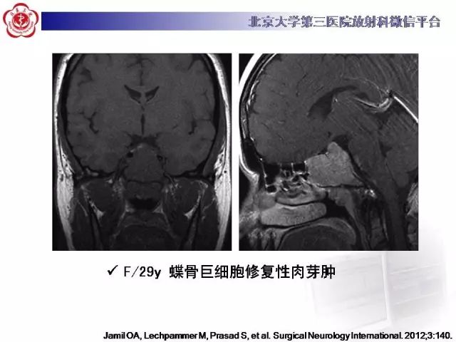 【病例】颅骨巨细胞修复性肉芽肿1例X线CT