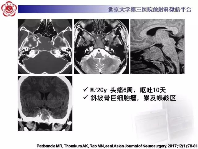 【病例】颅骨巨细胞修复性肉芽肿1例X线CT