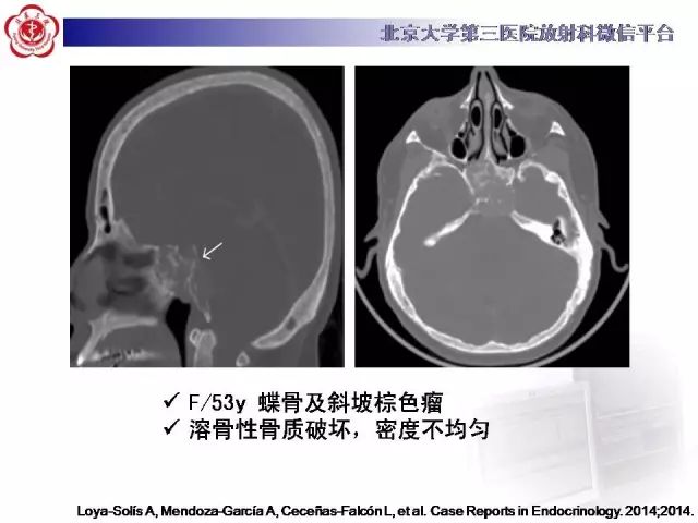 【病例】颅骨巨细胞修复性肉芽肿1例X线CT