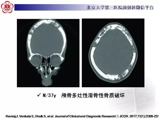 【病例】颅骨巨细胞修复性肉芽肿1例X线CT