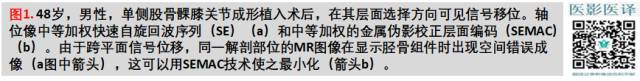 膝关节置换术后植入物的MR表现 膝关节置换术后植入物的MR表现
