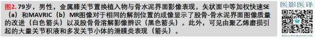 膝关节置换术后植入物的MR表现 膝关节置换术后植入物的MR表现