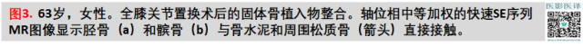 膝关节置换术后植入物的MR表现 膝关节置换术后植入物的MR表现