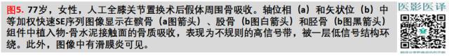 膝关节置换术后植入物的MR表现 膝关节置换术后植入物的MR表现