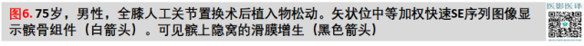 膝关节置换术后植入物的MR表现 膝关节置换术后植入物的MR表现