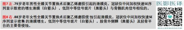 膝关节置换术后植入物的MR表现 膝关节置换术后植入物的MR表现
