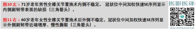 膝关节置换术后植入物的MR表现 膝关节置换术后植入物的MR表现