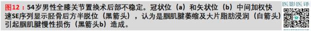 膝关节置换术后植入物的MR表现 膝关节置换术后植入物的MR表现