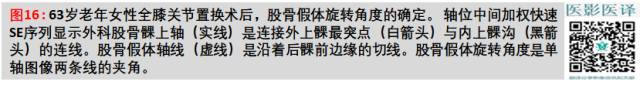 膝关节置换术后植入物的MR表现 膝关节置换术后植入物的MR表现