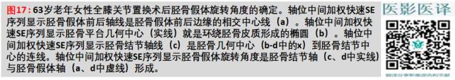膝关节置换术后植入物的MR表现 膝关节置换术后植入物的MR表现