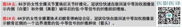 膝关节置换术后植入物的MR表现 膝关节置换术后植入物的MR表现