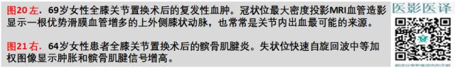 膝关节置换术后植入物的MR表现 膝关节置换术后植入物的MR表现