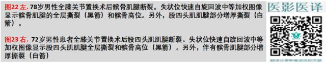 膝关节置换术后植入物的MR表现 膝关节置换术后植入物的MR表现