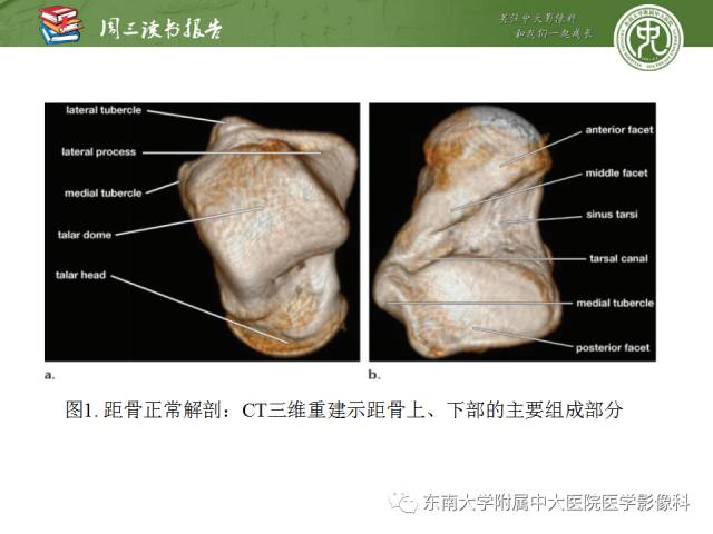 【PPT】距骨骨折与脱位：放射科医师及时诊断与分类指南