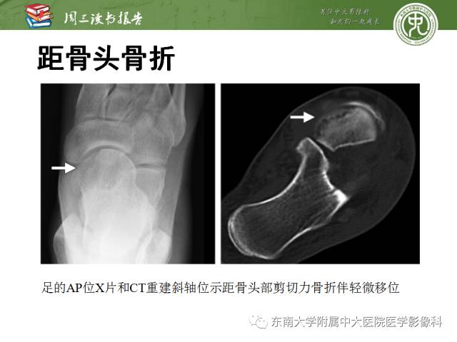 【PPT】距骨骨折与脱位：放射科医师及时诊断与分类指南
