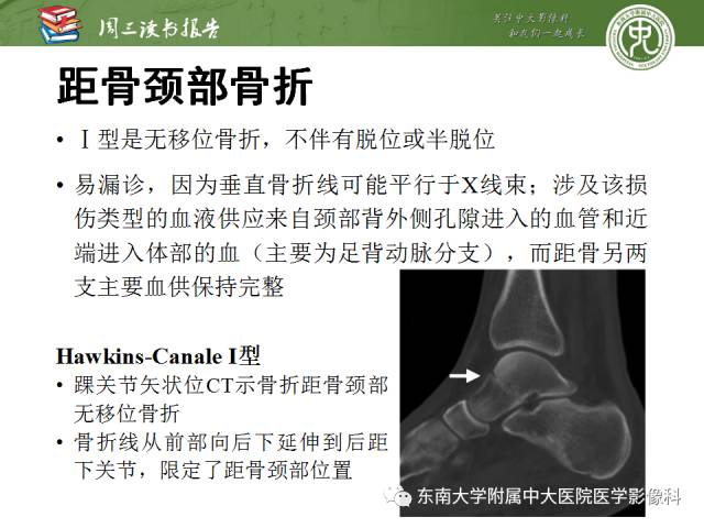 【PPT】距骨骨折与脱位：放射科医师及时诊断与分类指南