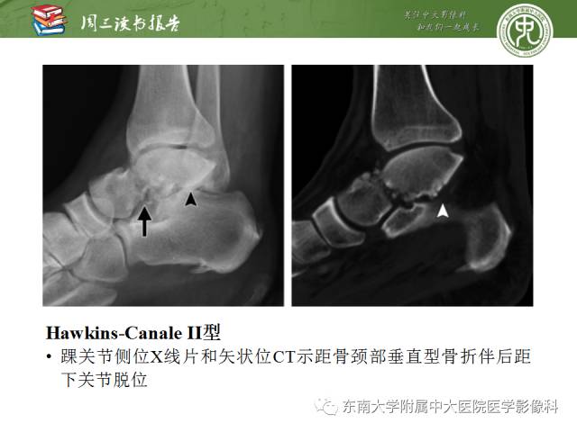 【PPT】距骨骨折与脱位：放射科医师及时诊断与分类指南
