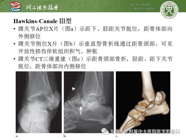 【PPT】距骨骨折与脱位：放射科医师及时诊断与分类指南