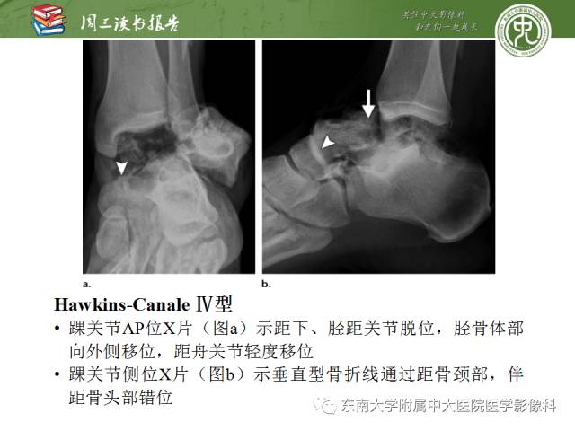 【PPT】距骨骨折与脱位：放射科医师及时诊断与分类指南