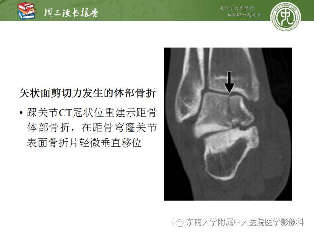 【PPT】距骨骨折与脱位：放射科医师及时诊断与分类指南