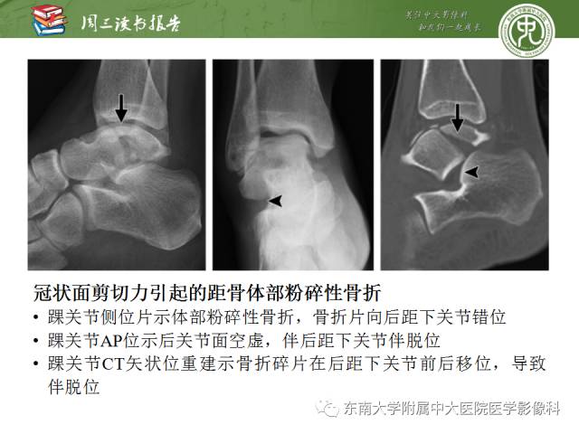【PPT】距骨骨折与脱位：放射科医师及时诊断与分类指南