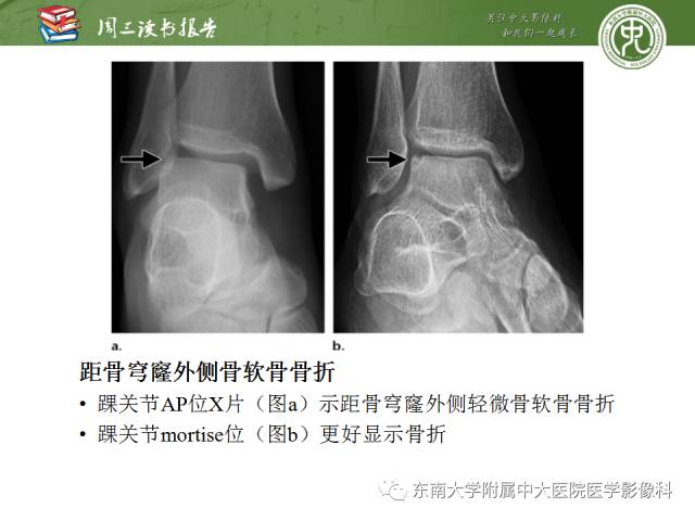 【PPT】距骨骨折与脱位：放射科医师及时诊断与分类指南