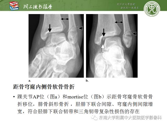 【PPT】距骨骨折与脱位：放射科医师及时诊断与分类指南