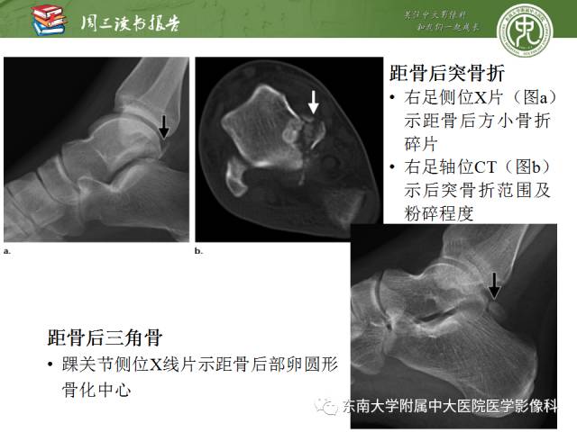 【PPT】距骨骨折与脱位：放射科医师及时诊断与分类指南