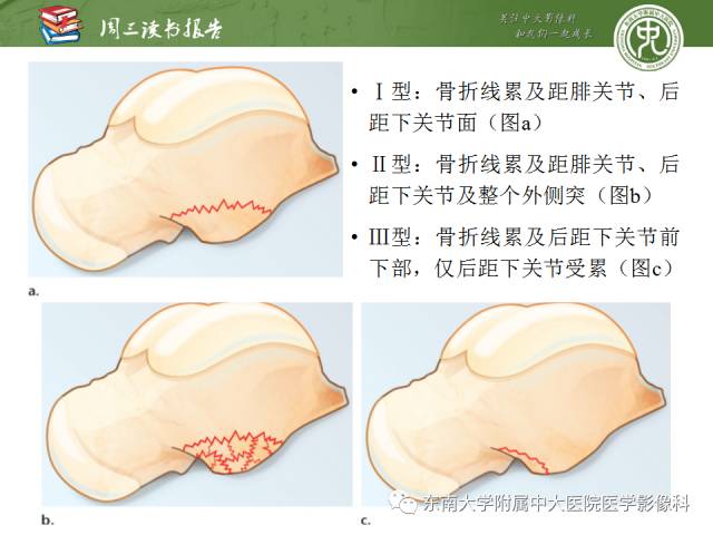 【PPT】距骨骨折与脱位：放射科医师及时诊断与分类指南