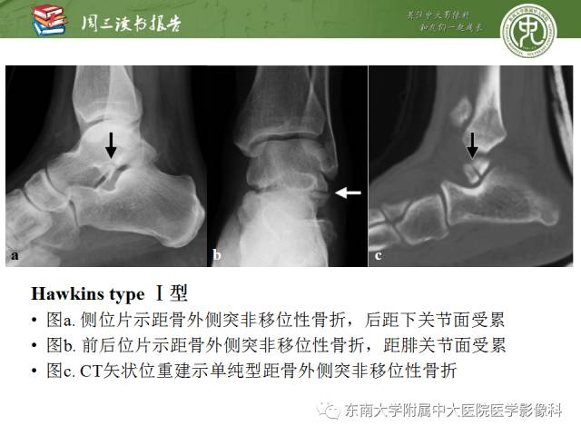 【PPT】距骨骨折与脱位：放射科医师及时诊断与分类指南