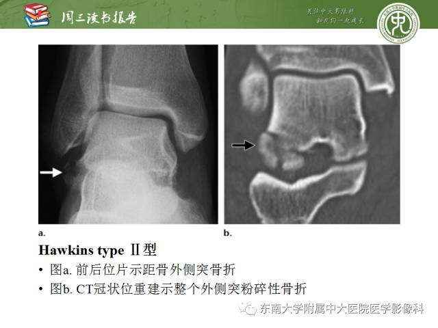 【PPT】距骨骨折与脱位：放射科医师及时诊断与分类指南