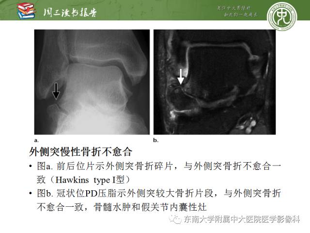 【PPT】距骨骨折与脱位：放射科医师及时诊断与分类指南