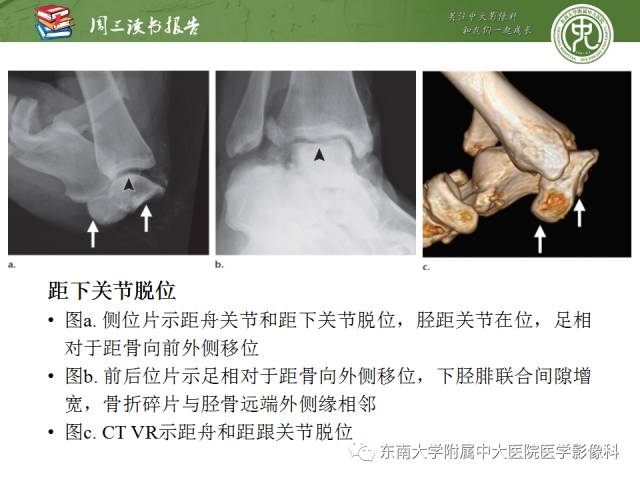 【PPT】距骨骨折与脱位：放射科医师及时诊断与分类指南