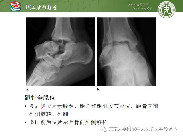 【PPT】距骨骨折与脱位：放射科医师及时诊断与分类指南