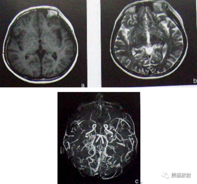 烟雾病（Moyamoya disease）、CT及MRI表现