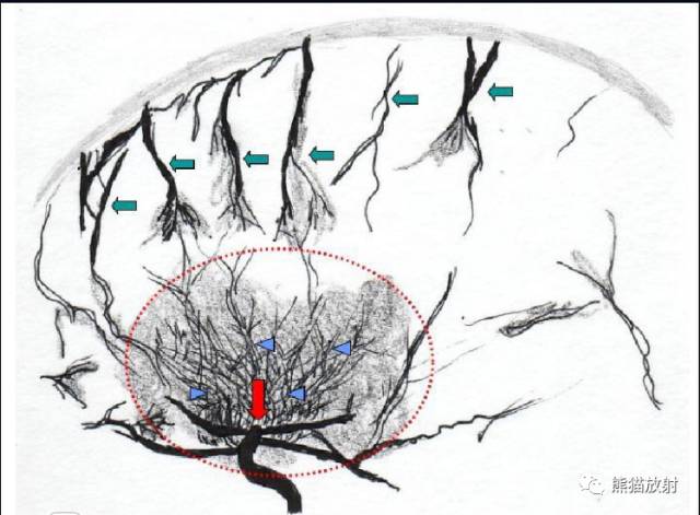 烟雾病(Moyamoya disease)、CT及MRI表现 烟雾病(Moyamoya disease)、CT及MRI表现