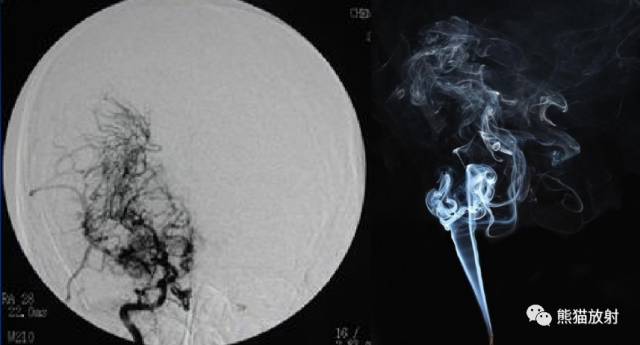 烟雾病(Moyamoya disease)、CT及MRI表现 烟雾病(Moyamoya disease)、CT及MRI表现