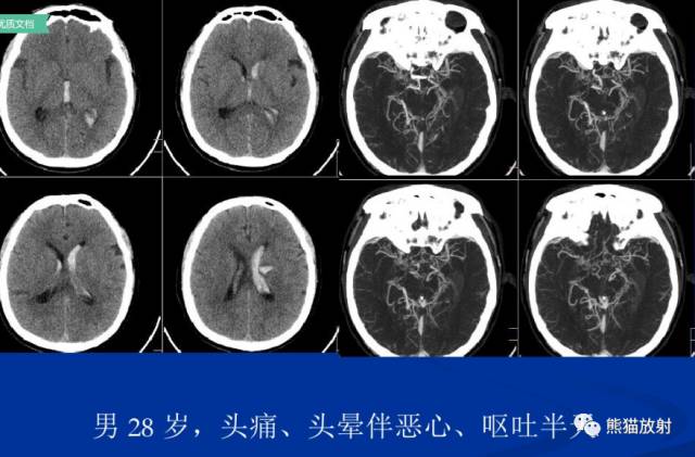烟雾病(Moyamoya disease)、CT及MRI表现 烟雾病(Moyamoya disease)、CT及MRI表现
