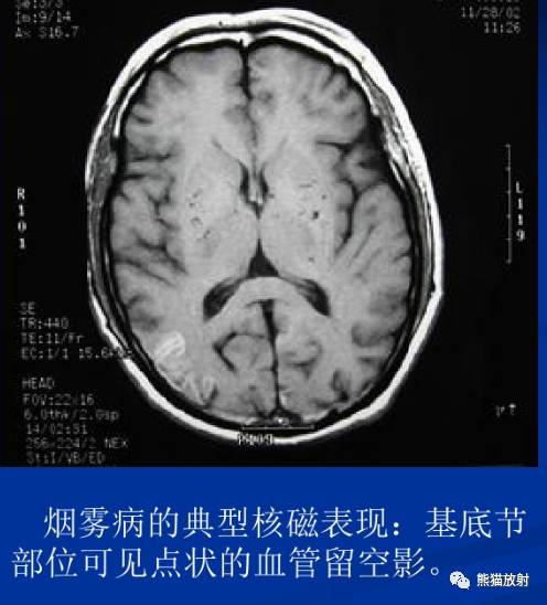 烟雾病(Moyamoya disease)、CT及MRI表现 烟雾病(Moyamoya disease)、CT及MRI表现