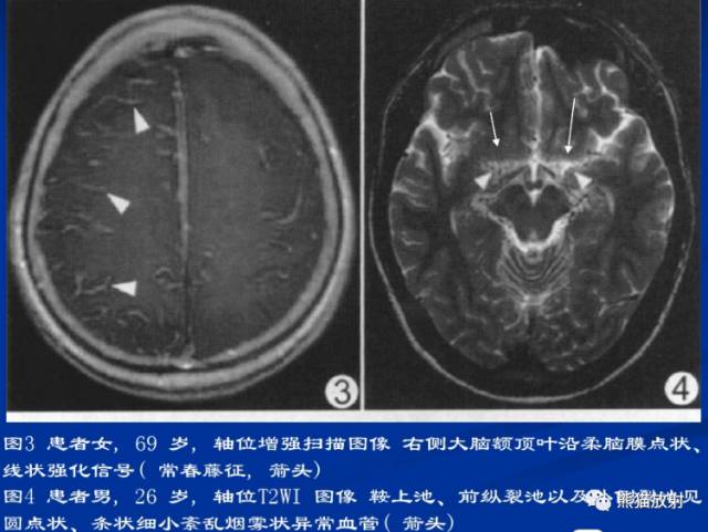 烟雾病(Moyamoya disease)、CT及MRI表现 烟雾病(Moyamoya disease)、CT及MRI表现
