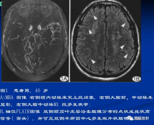 烟雾病(Moyamoya disease)、CT及MRI表现 烟雾病(Moyamoya disease)、CT及MRI表现