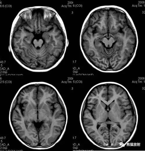 烟雾病(Moyamoya disease)、CT及MRI表现 烟雾病(Moyamoya disease)、CT及MRI表现
