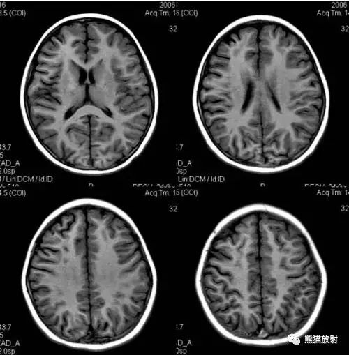 烟雾病(Moyamoya disease)、CT及MRI表现 烟雾病(Moyamoya disease)、CT及MRI表现