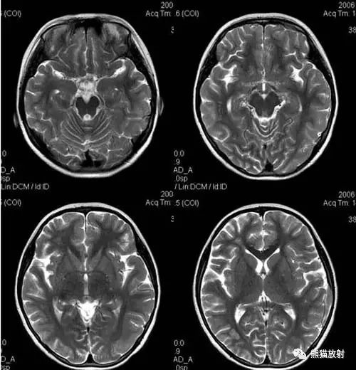 烟雾病(Moyamoya disease)、CT及MRI表现 烟雾病(Moyamoya disease)、CT及MRI表现